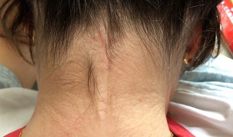 Cicatriz vertical no pescoço de uma mulher.